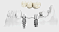 multiple implant, bridge supported by implant, tooth fix by screw, screwed tooth