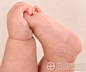 植物疗法：手脱皮、脚跟痛、手脚抽筋、脚鸡眼、手脚皲裂的治疗_中医食疗_中国有机生活
