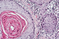 Histological tissue section from a sample of lung squamous carcinoma.