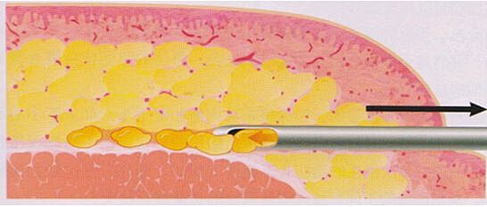 脂肪吸脂示意图
