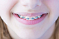 带牙套的美女高清图片 - 素材中国16素材网