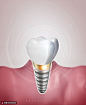 闪亮牙齿种植新生牙龈螺丝医美海报海报招贴素材下载-优图网-UPPSD