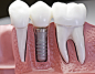 全部尺寸 | dental implants 2 | Flickr - 相片分享！