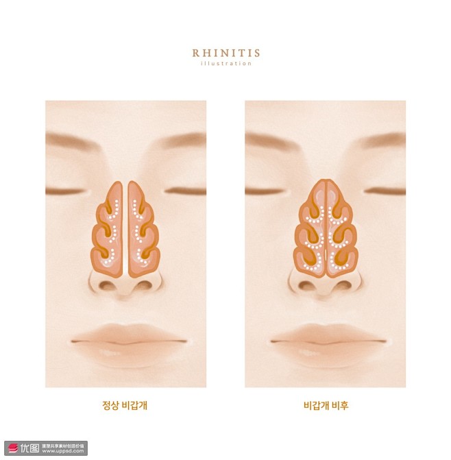 面部特写 鼻腔疾病 病变对比 医疗健康插...