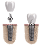 implant0.png (1101×1214)