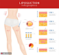 腿部吸脂 脂肪组织 腿部特写 整形插图插画AI05医疗保健素材下载-优图网-UPPSD