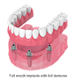 Leeming-dental-Full-Mouth-Implants.png (960×1043)