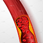血管阻塞，有胆固醇血栓的动脉。3d静脉与血块向量插图