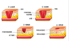 抠脚皮的仙女采集到疤痕