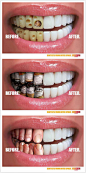 牙齿保护广告：比较重口味的一则平面广告。广告创意算不上有多新奇，但画面表现力非常棒。护牙前后的鲜明对比，冲击力还是很强的。