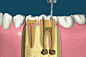 牙根管治疗以及补牙的动画演示！