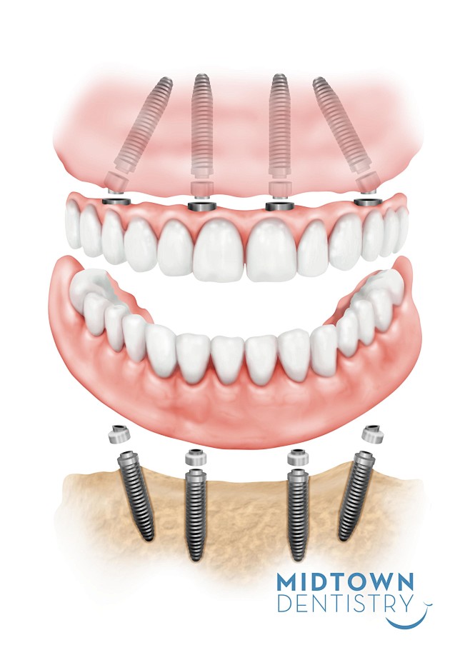 图片：All-on-4 implant ...