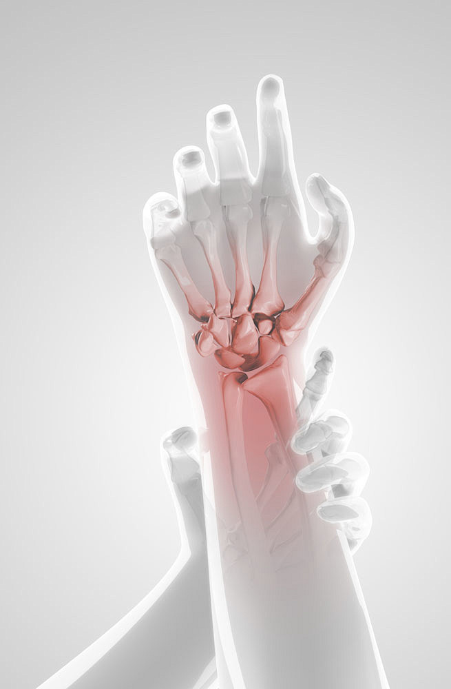 手腕X光图像图片_疼痛 _T201812...
