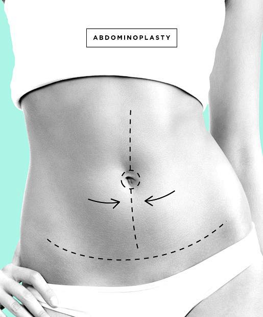 Tummy Tuck aka Abdom...