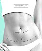 Tummy Tuck aka Abdominoplasty. A popular proceure after babies and weight loss. Phone us for more info 07 4031 5755.