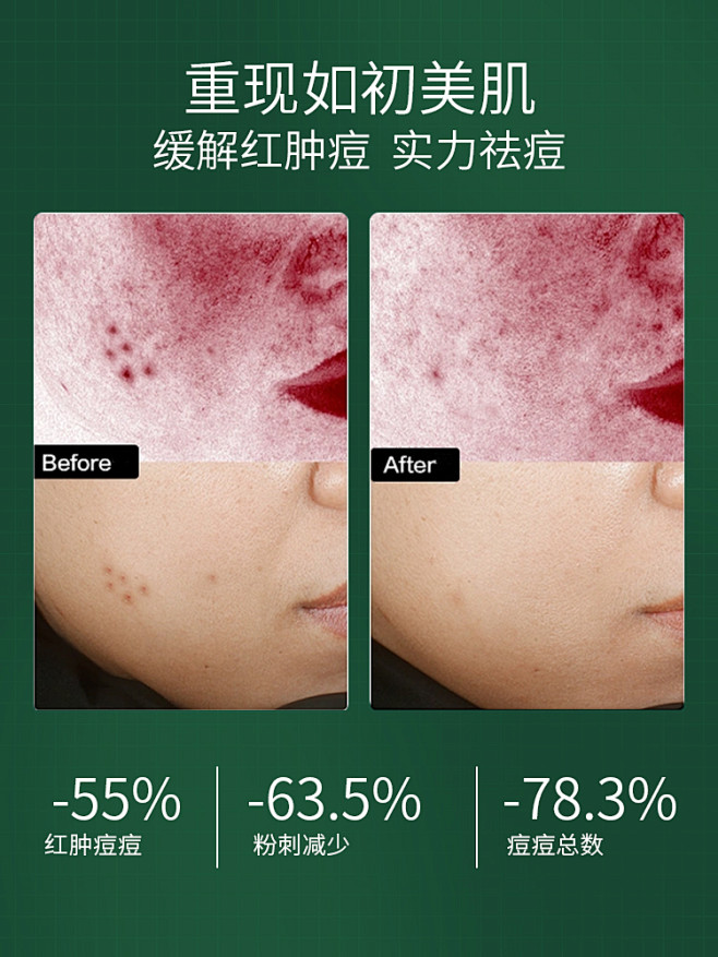 byhr祛痘膏霜凝胶祛痘膏控油去痘印女痘...
