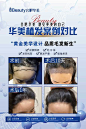 植发案例对比海报展板-源文件分享-ywjfx.cn