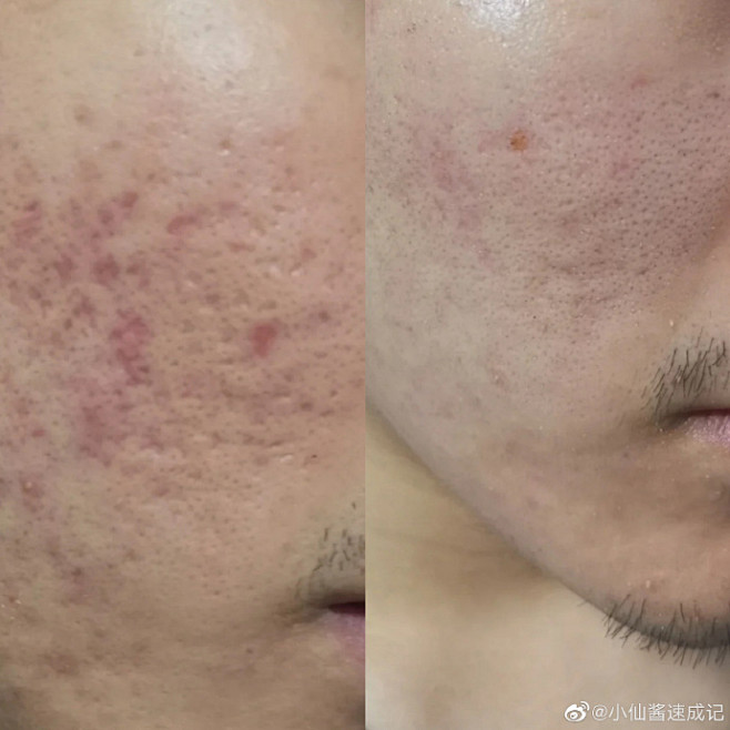 泉州祛痘坑+痘印分享: 痘坑+红色痘印，用啥有效？ 二氧化碳点阵+光子m22,配合改善。大家可以看到小哥的主要是车厢型、冰锥型坑，难度还是蛮大 ...