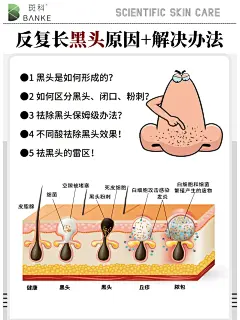 ［反复长黑头的原因］与解决办法❗️ - 小红书