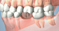 缺失一颗牙齿后，周边牙齿的变化，这也是牙齿缺失为什么一定要选择种植牙的原因 ​​​​