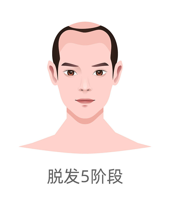 男性脱发-脱发5阶段