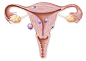 Uterine fibroma, illustration