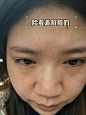 超皮秒祛斑