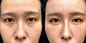终于告别黑眼圈了，嗨体太管用了