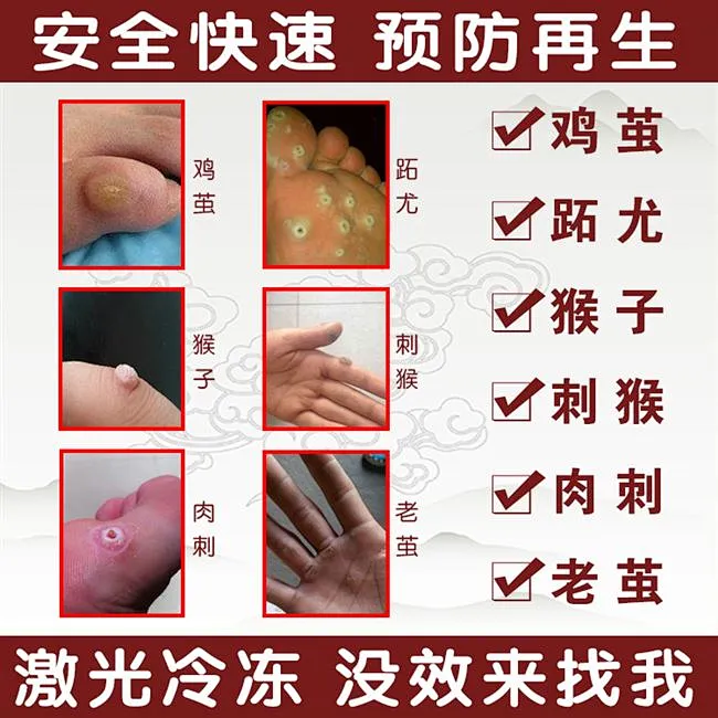 适用于血胞刺去除膏刺猴手部鸡候消鱼鳞痣祛尤液的药疣瘊净修子肉-淘宝网-花瓣网