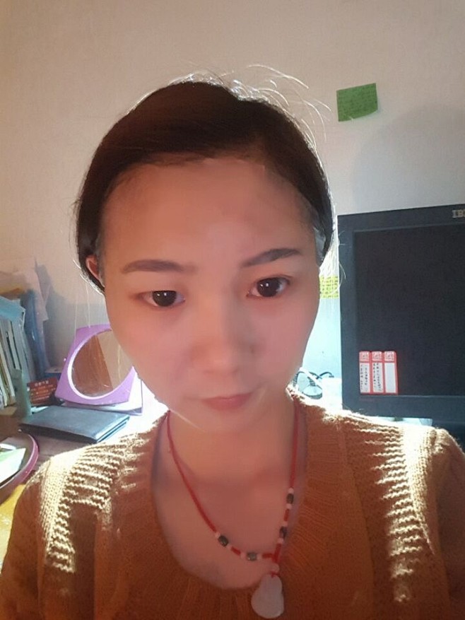 脸上的豆豆和都已慢慢的消失