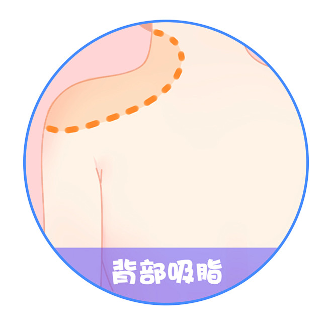 大腿 腰部 肩部 胳膊 臀部 吸脂 吸脂...