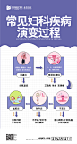 妇科疾病演变过程海报-素材库-sucai1.cn