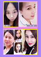 【双眼皮+开眼角】芭比无辜大眼睛（切开双眼皮+开内眼角）_整形优惠预约-新氧美容整形