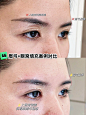 眼窝凹陷别直接填 看完这篇成功上岸‼️ - 小红书