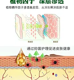 铜钱癣药膏皮肤瘙痒红斑外用止痒金钱手肘铜钱藓牛皮癣头癣专用药-淘宝网