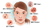 最全面的对痤疮痘痘的认知和护理 - 热点网