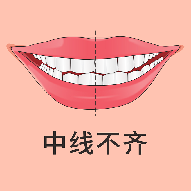 中线不齐
