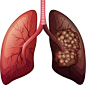 体检发现肺部有个阴影是怎么回事？可能是四种疾病导致一定要重视