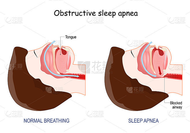 Obstructive Sleep Apnea.