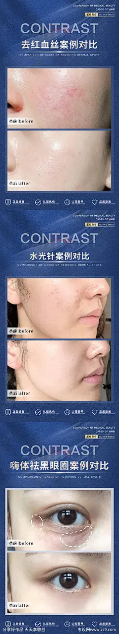 医美案例术后对比海报-源文件分享-ywjfx.cn