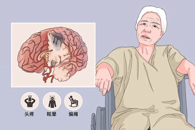 中风前有哪些征兆？千万别忽视！ : 中风前有哪些征兆？千万别忽视！,脑中风,高血压,脑梗塞,脑出血,糖尿病