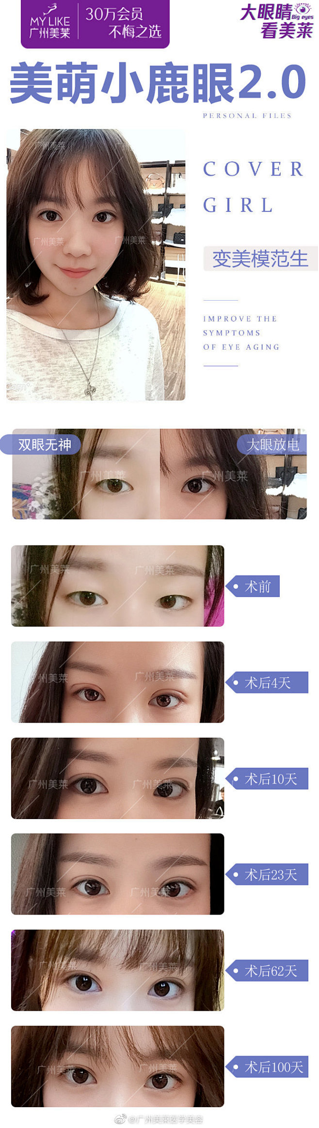 术前： 单眼皮、上睑下垂、给人无神睡不醒...