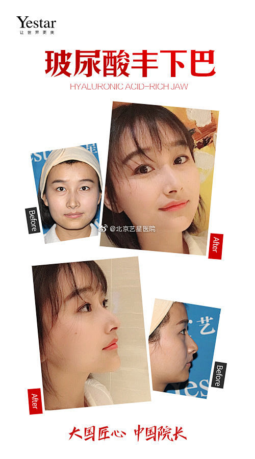 玻尿酸丰下巴

微调效果赞修饰下巴边缘线...