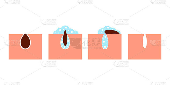 深层清洁皮肤毛孔，去除黑头，护肤。清洗面部皮肤污垢的程序。去除皮脂并用洗涤剂清洗。矢量图