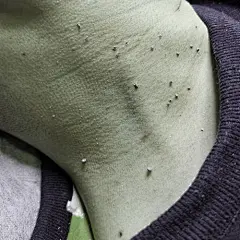 丝状疣_百度图片搜索