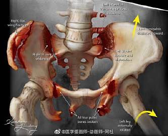 严重受伤的骨盆的 X 光照片复原成医学插...