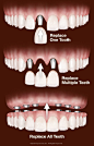 Hans R. Koenig DMD, PA - Implant Crowns