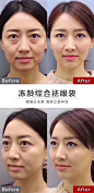 去眼袋手术案例对比
眼袋足足显老十岁
内路无痕祛眼袋
损伤小，肿胀不明显，无须缝合⚡
#杭州艺星##2020，带美丽回家# ​​​​