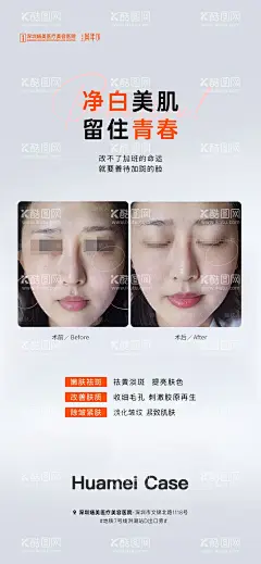 案例海报  - 源文件下载【酷图网】海报,医美,美白,祛斑,案例,对比,