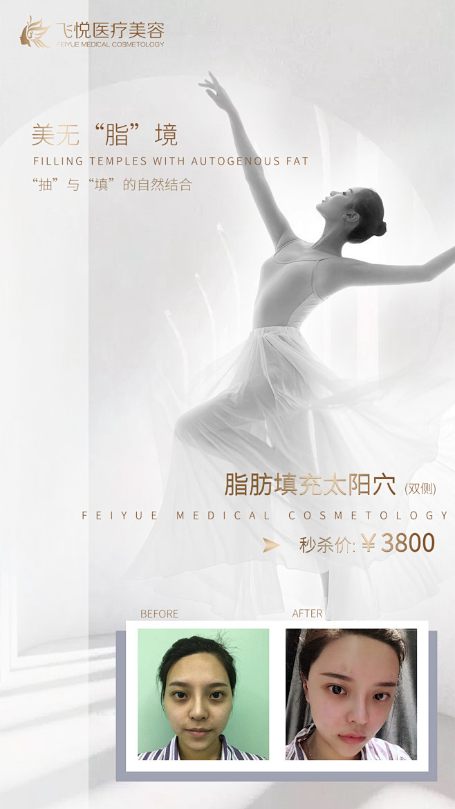 医美海报 脂肪填充 脂肪面部填充太阳穴